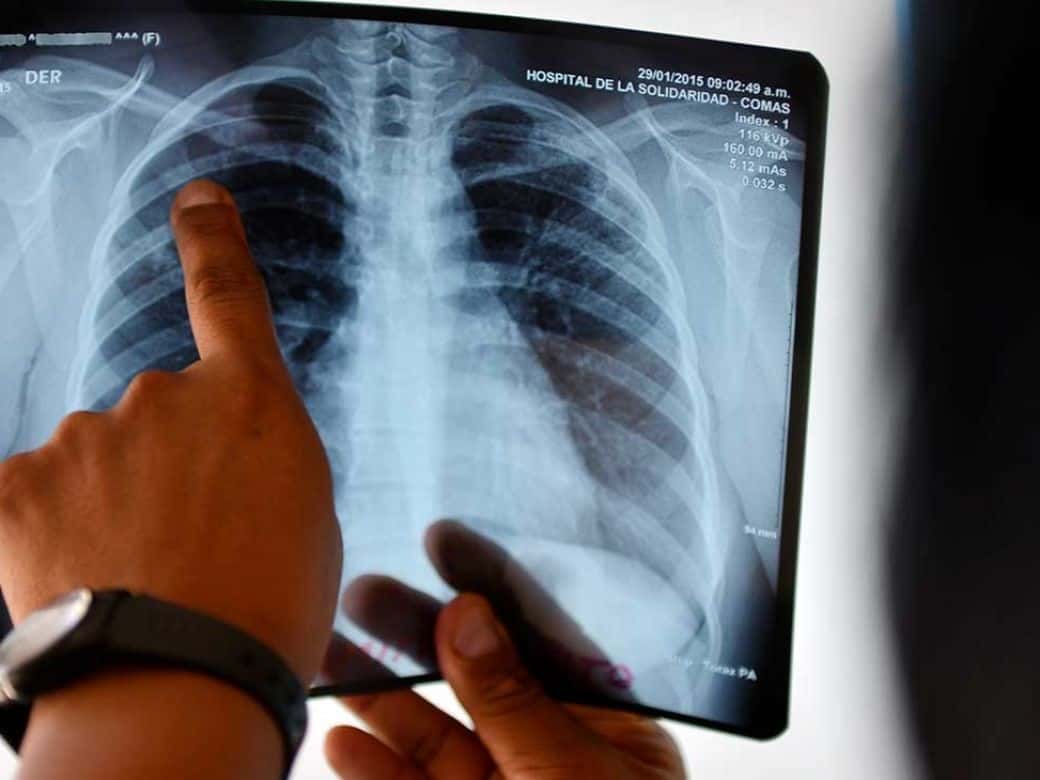 La OMS pidió más financiación para combatir la tuberculosis