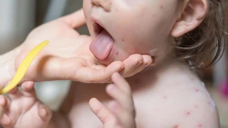 “Síndrome mano-boca-pie”: de qué se trata esta enfermedad que afecta a los niños 