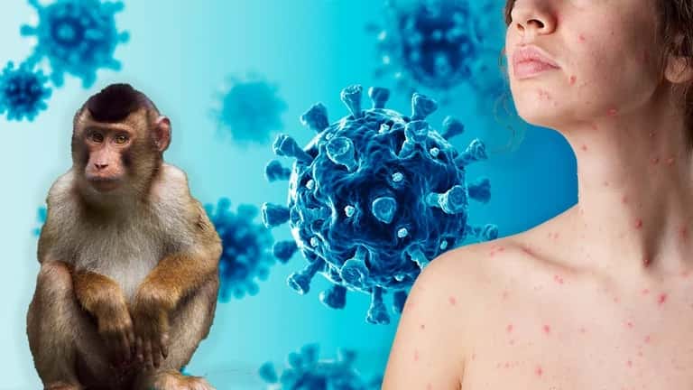 Viruela del mono: estiman que no se tardará mucho  en declarar la pandemia