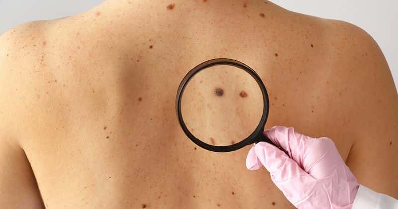 "La incidencia del melanoma es variable en diferentes países o continentes. Australia, por ejemplo, tiene una de las incidencias más altas del mundo.